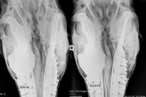 tumor